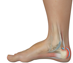 Achilles Tendon Bursitis