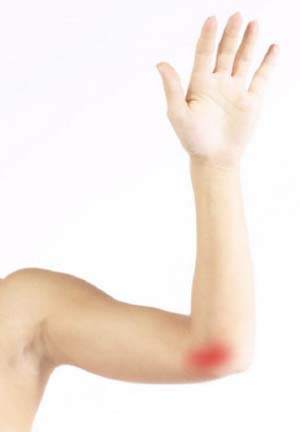 Ulnar Nerve Entrapment Novi, MI  Cubital Tunnel Syndrome Farmington Hills,  MI