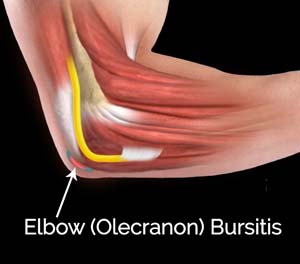 Olecranon (Elbow) Fractures