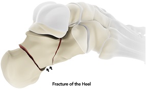 Heel Fractures