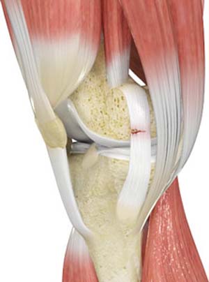 Ligament Injuries Treatment West Bloomfield, MI