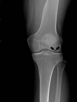 Osteochondritis Dissecans