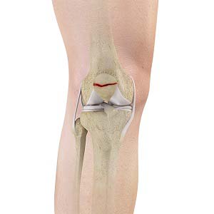 signs of a fractured kneecap