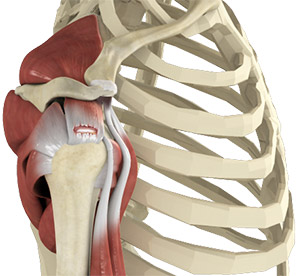 Rotator Cuff Tear