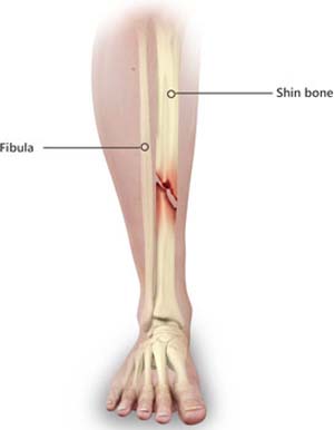 Shinbone Fractures